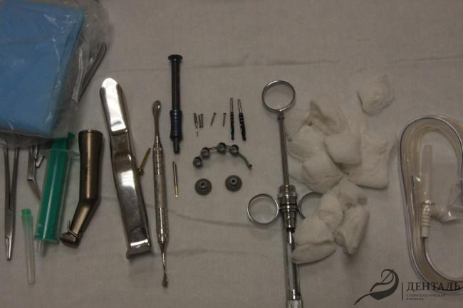 Имплантация по накостному хирургическому шаблону 